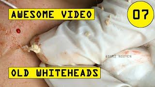 Suri Job 07: AWESOME OLD WHITEHEADS