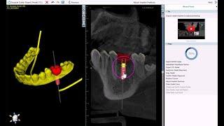 BSP V4.13: Improved Surgical Guide Wizard Flow with New Functionality