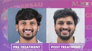 Your Smile, Transformed | Clear Aligners | Invisible Braces | Aligners4U | Hyderabad | India | Teeth