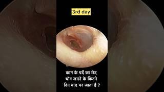 चोट लगने से फटा कान का पर्दा अपने आप कैसे भर जाता है ? Traumatic Eardrum rupture