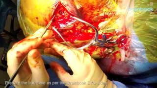 Ventriculo-peritoneal shunt - GoPro footage