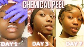 My First Chemical Peel EVER! + raw results