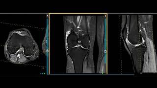 22 YEAR OLD WITH LATERAL KNEE PAIN WITH WALKING