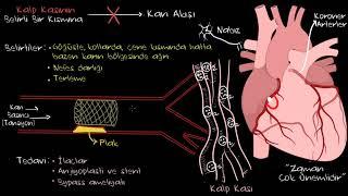 Kalp Krizi Nedir? Kalp Krizi, Anjiyo, Stent, Bypass Konu Anlatımı (Sağlık Bilgisi ve Tıp)