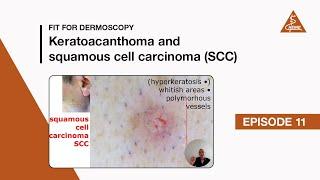 Fit for Dermoscopy Episode 11 - Keratoacanthoma and Squamous Cell Carcinoma (SCC)