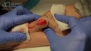 Lipoma Removal