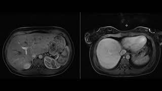 Hepatic Adenoma