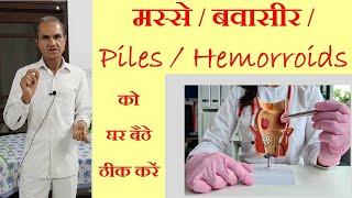 मस्से / बवासीर को ठीक करने का अचूक उपाय !!! Treat Piles / Hemorroids Naturally at Home !!!