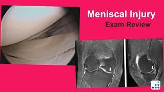 Meniscal Injury Exam Review - Raymond Kim, MD