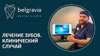  Лечение зубов. Клинический случай лечения пациента в Belgravia Dental Studio