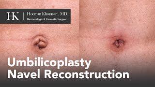 Umbilicoplasty, belly button revision surgery by Dr. Khorasani | Quadruple Board-Certified Surgeon