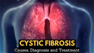 CYSTIC FIBROSIS, Causes, Signs and Symptoms, Diagnosis and Treatment.