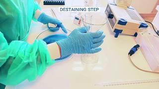 Serum protein electrophoresis