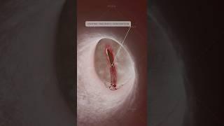 What is traumatic tympanic membrane perforation and how does it affect hearing? Ear anatomy in 3D