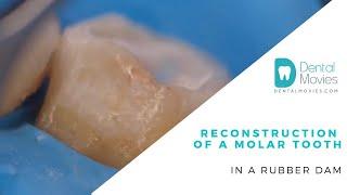 Reconstruction of a molar tooth in a rubber dam