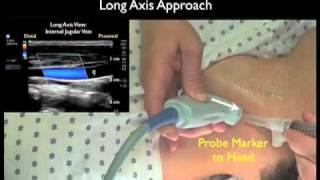 How To: Ultrasound Guidance for Central Venous Access Part 2 Case Study Video