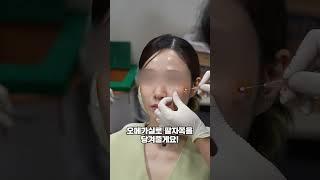 즉각적인 팔자주름 개선 효과를 보고싶다면? #팔자주름 #실리프팅 #쥬베룩