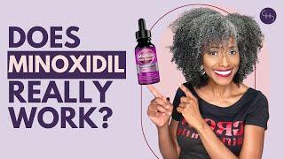 The SHOCKING Truth about Minoxidil for Hair Loss