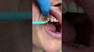 SILICONE TOOTH ||  #dentist #viral #mouthcancer #celebritydentist #trending #youtubeshorts