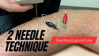 Electroacupuncture 2-Needle Technique by Dr. Anthony Lombardi