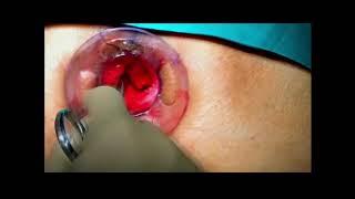 Dr Porwal Prolapse Conrad CME Proctology