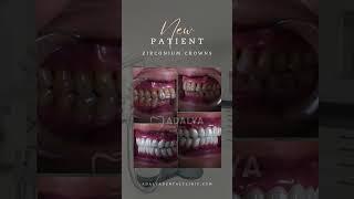Zirconium Crowns Turkey - Porcelain Dental Veneers Antalya