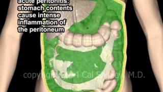 Peritonitis with Gastric perforation animation by Cal Shipley, MD.