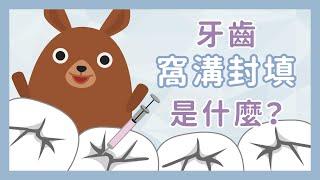 什麼是窩溝封填–更新版