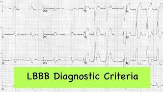 LBBB diagnostic criteria