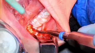 Lower Third Molar Impactions | Learn in 4K | OnlineExodontia.com