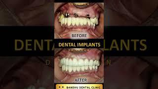 Best Dental Implants Delhi