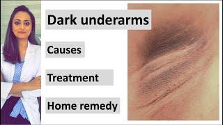 How to get rid of Dark underarms | causes|  treatment| home remedy| Dermatologist | Dr. Aanchal