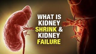 What isKidney Shrink & Kidney Failure? - Dr. Puneet Dhawan - Karma Ayurveda