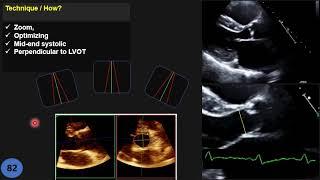 Tips & mistakes: LVOT diameter measurement