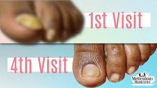 Pedicure Transformation from Detached Toenail  Healthy & Reattached