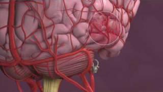 Migraines and Vertigo - Mayo Clinic