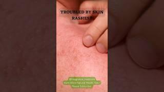 Skin Rash Natural Remedy! #youtubeshorts #shorts #viral #skincare #skinrashes #integrative_medicare