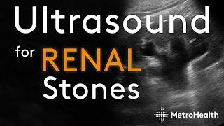 Ultrasound for Renal Stones
