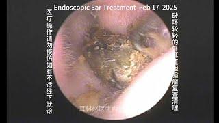 Re examination and cleaning of less severely damaged external auditory canal cholesteatoma 20250217