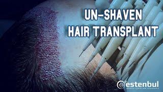 DHI Hair Transplant Turkey (Un-Shaven ) with Estenbul Health