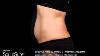 SculpSure Before & After | Timeless Beauty & Ageless Face