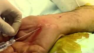 Guo Thread Carpal Tunnel Release