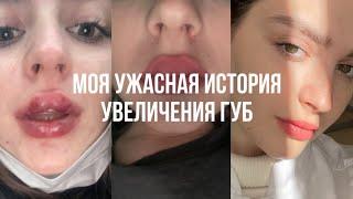 УВЕЛИЧЕНИЕ ГУБ | мой печальный опыт | как мне испортили губы