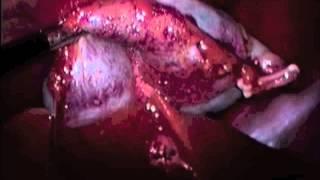 VetOvation: Canine Laparoscopic Cholecystectomy