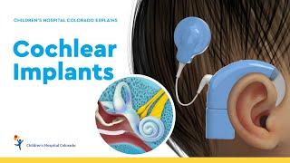 Pediatric Cochlear Implants and Hearing Loss