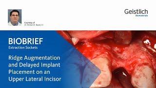 [Geistlich] Ridge Augmentation and Delayed Implant Placement by Dr. Bauer