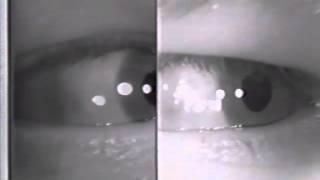 Abducting (Dissociated) Nystagmus