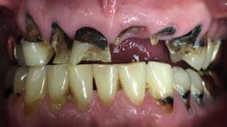 Meth Mouth - A Dentist's Worst Nightmare (Can It Be Treated?)