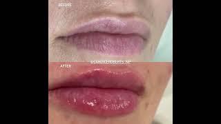 Beautiful Lip Filler by Candice Roberts, N.P.