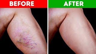 10 Natural Ways to Get Rid of Varicose Veins and Increase Blood Flow